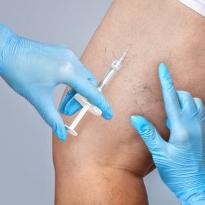 Escleroterapia (PEIM)